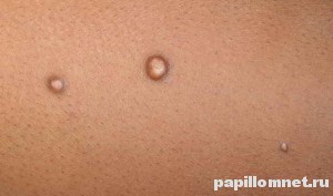 Фото проявления заболевания контагиозный моллюск на коже