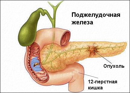 Опухоль в поджелудочной