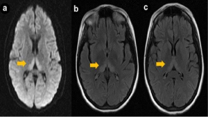 фото МРТ энцефалопатии головного мозга