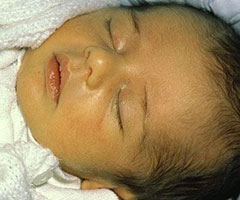 Лечение желтушки у новорожденных
