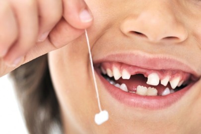 Выпадение зубов происходит у девочек раньше, чем у мальчиков.