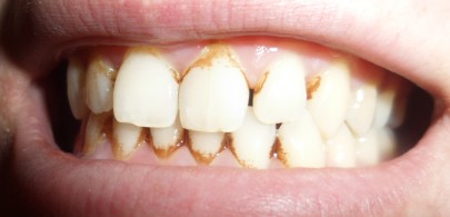 Камень на зубах – это налет, имеющий коричневый, зеленый, желтый или белый цвет. 