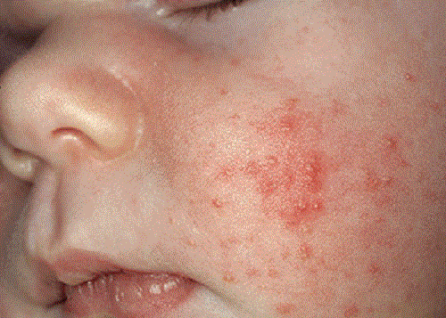 Аллергия на мед – симптомы и лечение