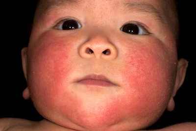 лечение аллергии у ребенка