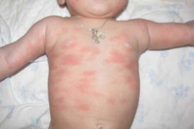 allergia-u-detey-5