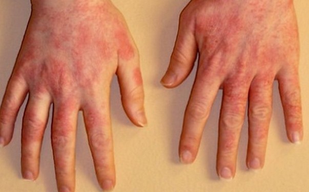 на фото аллергический дерматит рук