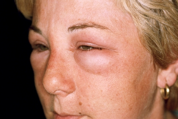 allergiya-na-chesnok-5