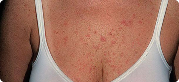 аллергия на груди