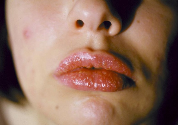 причины аллергии на губах