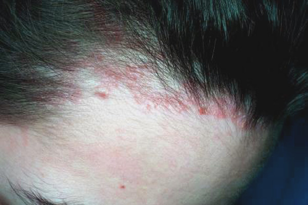 симптомы аллергии на хну