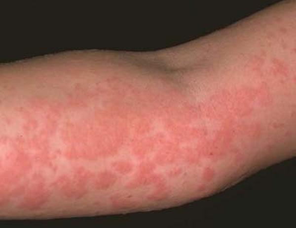 симптомы аллергии на хурму