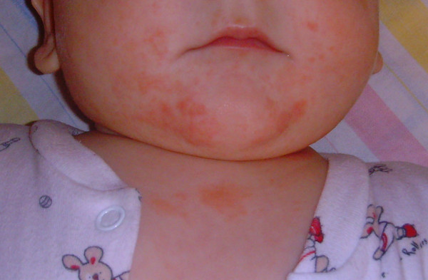 аллергия на шее и лице