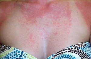Симптомы аллергии на солнце