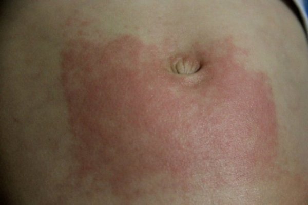 симптомы аллергии на животе