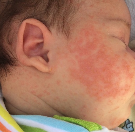 Аллергия у новорождённого