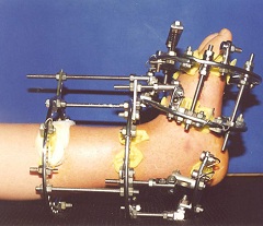 Аппарат Илизарова на ноге, фиксирующий кость