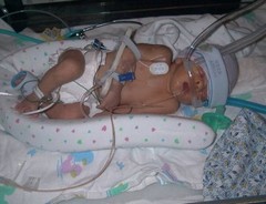 Помощь при асфиксии новорожденных