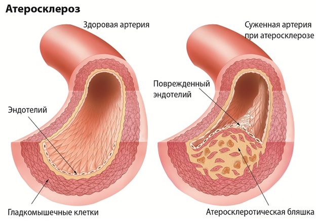 Атеросклероз артерий головного мозга.