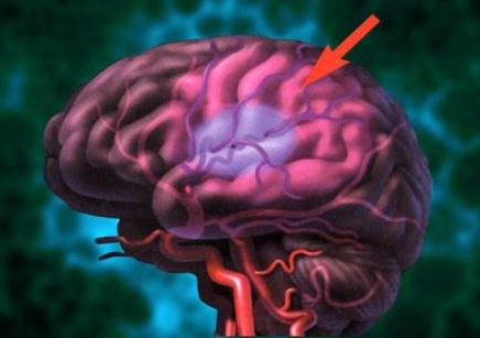 Последствия атеросклероза сосудов головного мозга. 