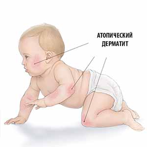 atopicheskij-dermatit-u-mladenca