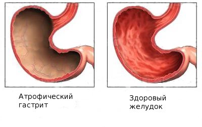 Гастрит атрофического типа