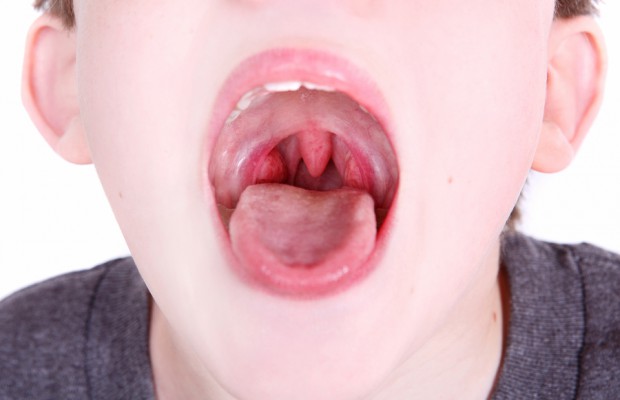 Open mouth view of tonsils in a child