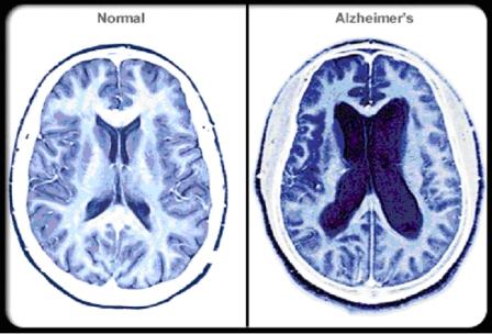 Последняя стадия Альцгеймера