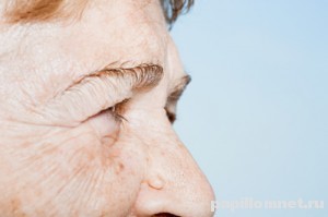 Фото бородавки на лице у пожилого человека