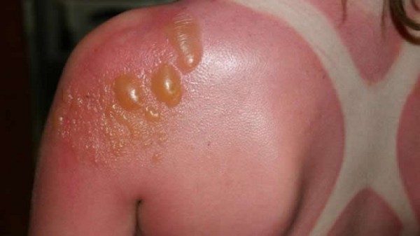 симптомы буллезного дерматита