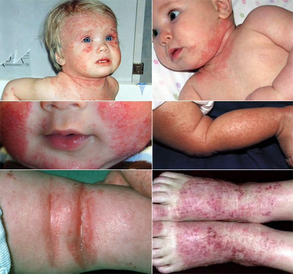 атопический дерматит у детей фото