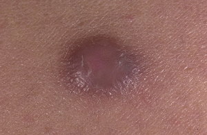 Фото дерматофибромы на коже
