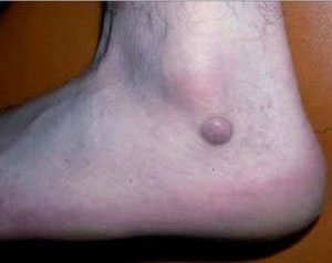 фиброма кожи на ноге