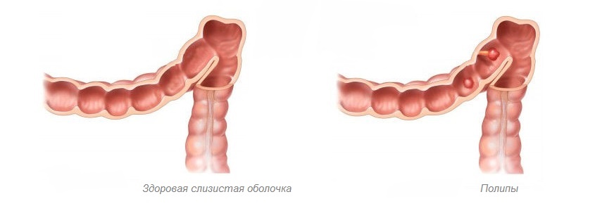 Полипы желудка представляют собой патологические разрастания тканей слизистой оболочки стенок желудка, возникающие в результате воздействия целой группы факторов.