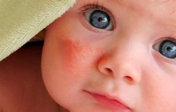 аллергия на щеке у ребенка