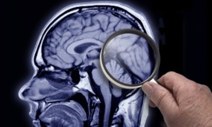 Пргноз дименции при эпилепсии