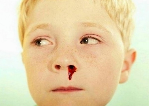 Эпистаксис — кровотечение из полости носа