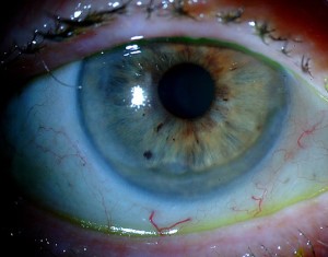 Эрозия роговицы глаза: лечение