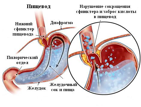 Нарушения сокращения сфинктера пищевода