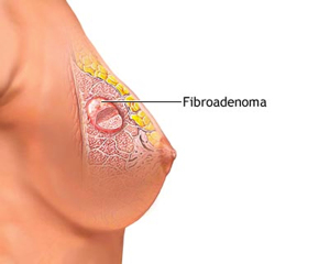 Схематичное изображение фибромы груди