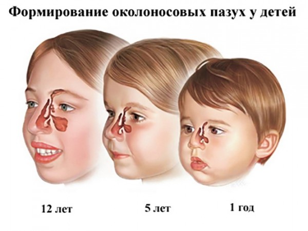 Формирование околоносовых синусов у детей разного возраста
