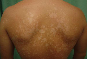 Фото пигментных пятен на спине человека