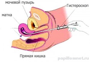 Фото процедуры гистерорезектоскопия полипа эндометрия