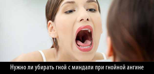 гнойники в горле при ангине