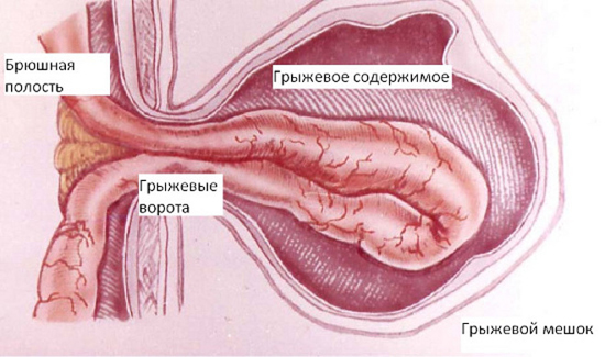 Грыжевые ворота