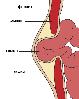 Схема проявления грыжи