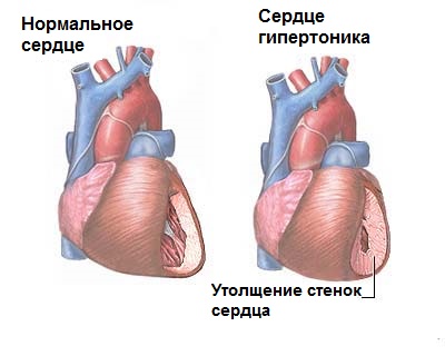 сердце гипертоника