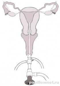 Схематичное фото гистероскопии матки, для удаления полипа
