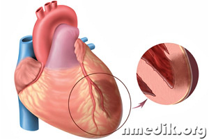 Одним из самых серьёзных осложнений является периоперационный инфаркт миокарда