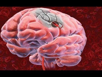 Отек головного мозга, ишемия