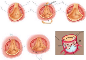 Хирургическое лечение включает иссечение и протезирование клапанов